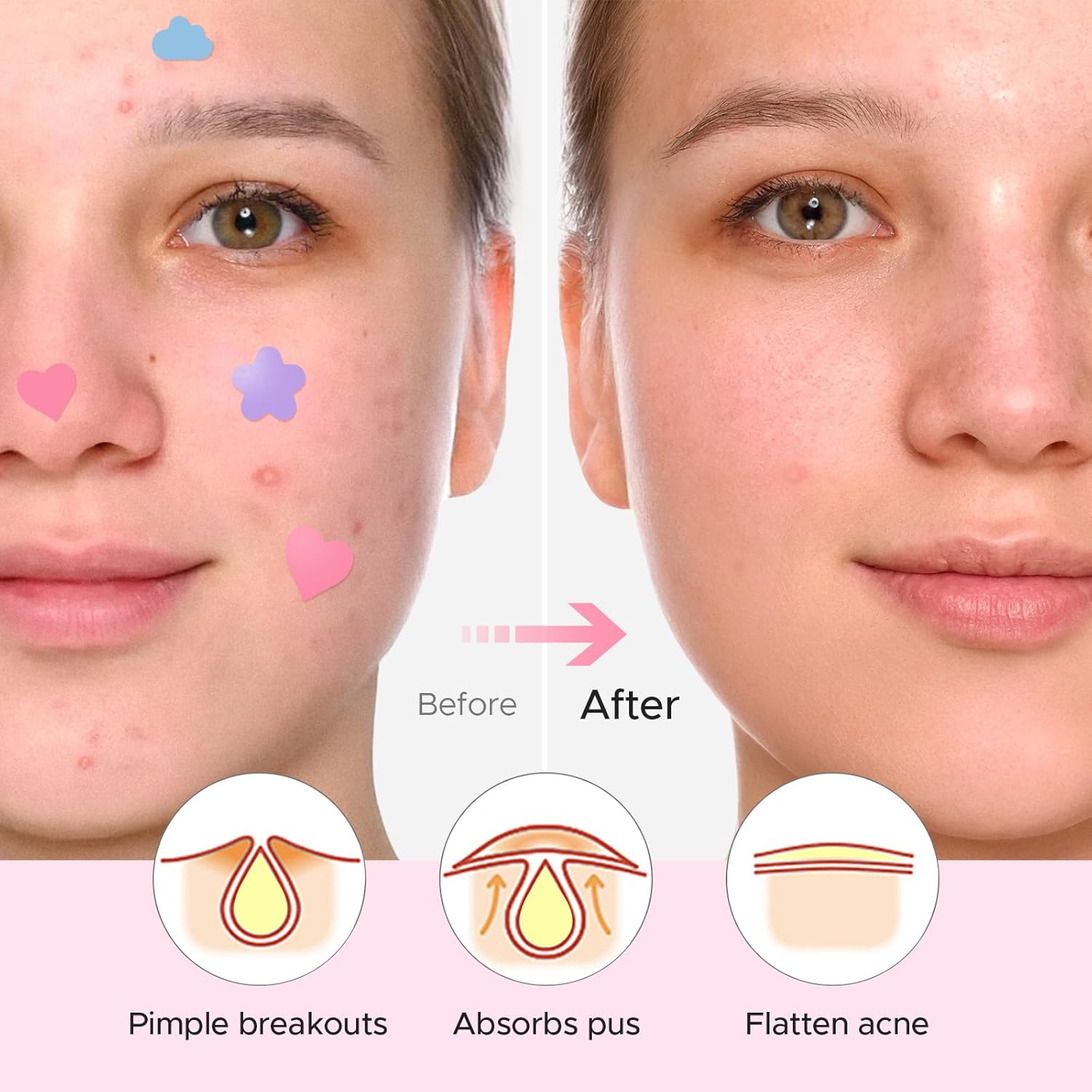 LitBear Acne Pimple Patch, 360 Dots 3 Shaped Colors Pimple Patches with Salicylic Acid, Tea Tree Oil & Calendula Oil, Hydrocolloid Acne Patch for Face, Blemish, Cute Zit Patch Pimple Sticker Acne Dots